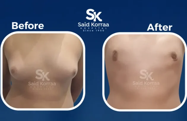 تثدي الرجال  x