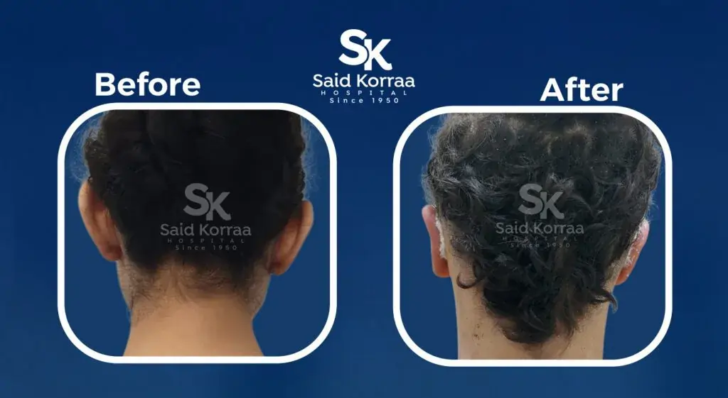 تجميل الاذن 