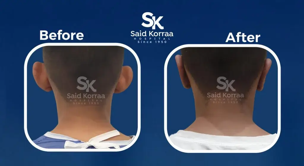 تجميل الاذن 