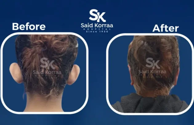 تجميل الاذن  x
