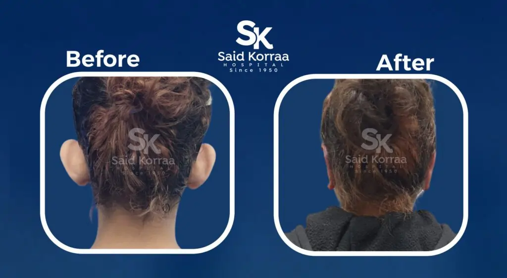 تجميل الاذن 