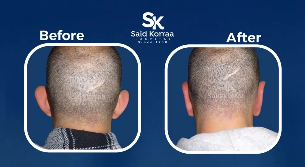 تجميل الاذن 