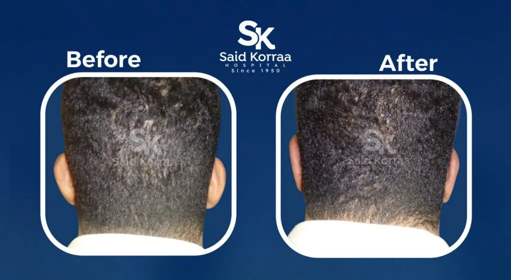 تجميل الاذن 