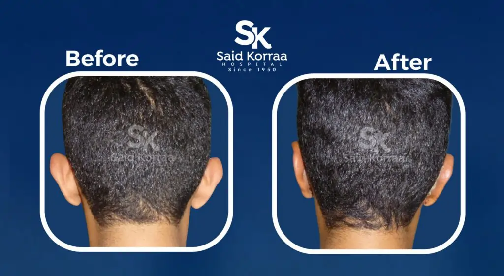 تجميل الاذن 