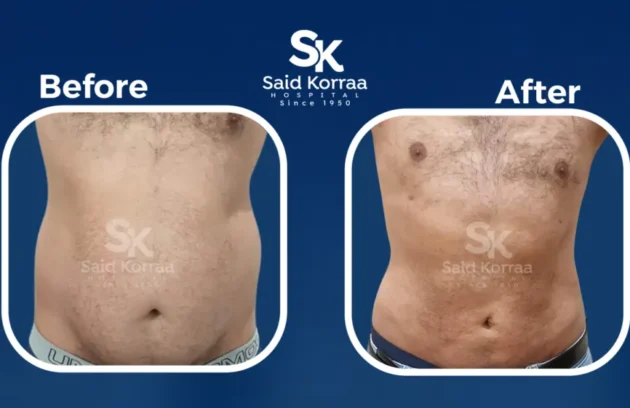 شفط الدهون  x